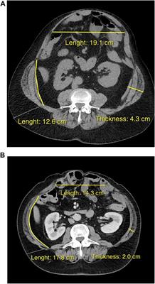 Risk Factor-Driven Prehabilitation Prior to Abdominal Wall Reconstruction to Improve Postoperative Outcome. A Narrative Review